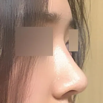 비대칭, 복코교정 했어요