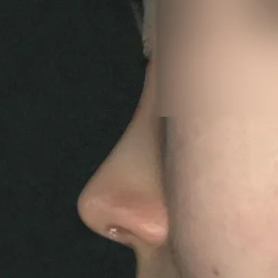 서승조 원장님께 코수술 받은지 1달차에요!