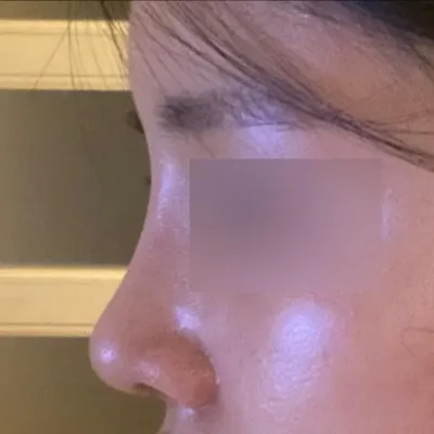 서승조 원장님께 수술 받은 지 한 달 차 후기에요