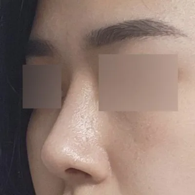 작은 복코 수술 2달 되었습니다!