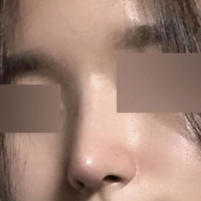 직반 라인으로 수술한지 2개월 됐습니다