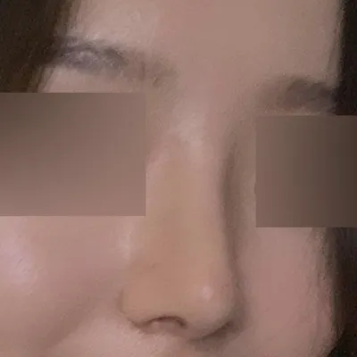 위버스에서 수술한지 드디어 2달 됐습니당