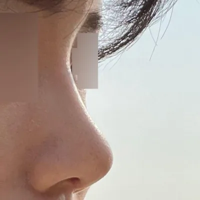 오늘 드디어 안쪽 실밥 제거하고왔어요!