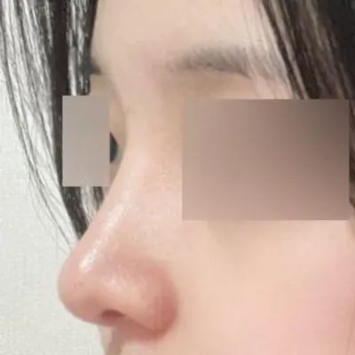 위버스에서 수술한지 3달 지났네용ㅎ