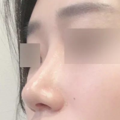 복코수술한지 이제 3개월 됐어요!!!