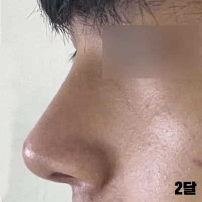 수술할때 콧볼 축소도 같이 했는데 만족합니다.