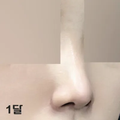 한달지나니까 더 붓기 쭉쭉 빠지는 것 같아영~