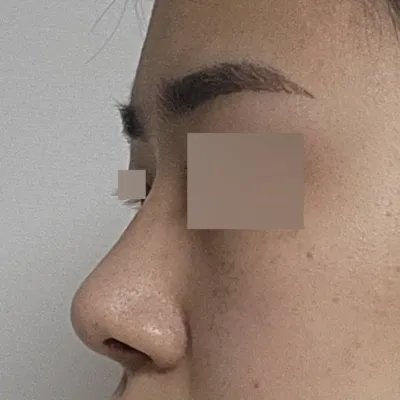 수술한지 3개월 되었습니다.