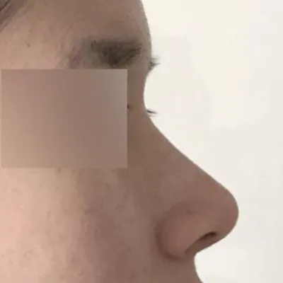 코 수술 받은 3달차 후기!
