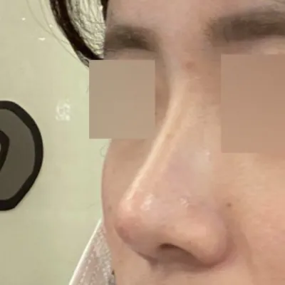 코수술 받은지 이제 두달 됐어요!