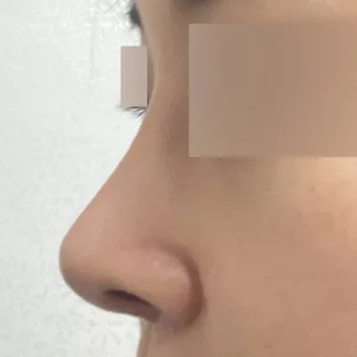 찝힌 용코 재수술 했어요