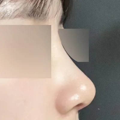 컴플렉스였던 코가 예뻐졌어요!