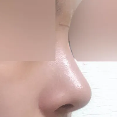 코 수술하고 3개월 후기에