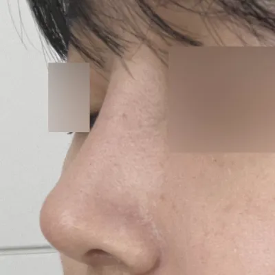 코 수술 한달차 성공했어요!