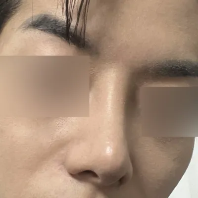 큰 복코 재수술 정말 만족합니다.