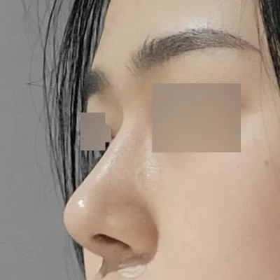 위버스에서 수술한지 5개월차입니다