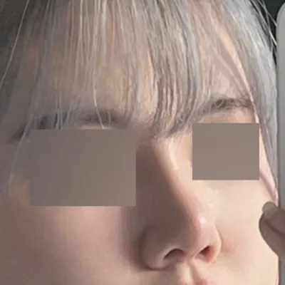보정하지 않아도 이쁜 코에 감동+원장님께 너무 감사해요!