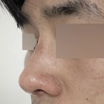 붓기가 빠져서 더 자연스러워지길 기대하고 있습니다