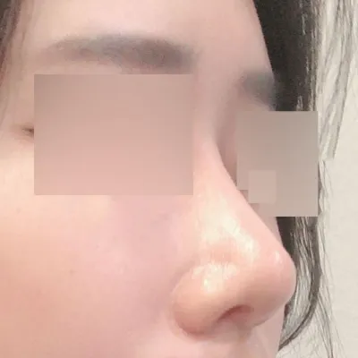 내 코가 생 긴지 반년 지난 후기에여!