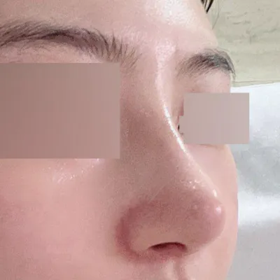 제 워너비 코 만들어주신 서승조원장님 감사합니다!