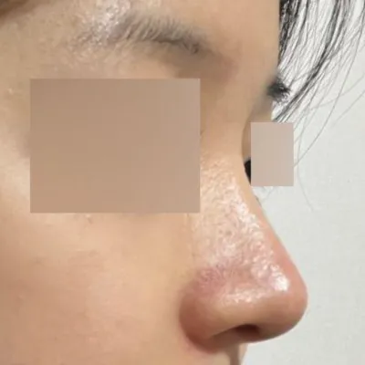 코수술한지 벌써 반년 됐네용ㅎㅎ