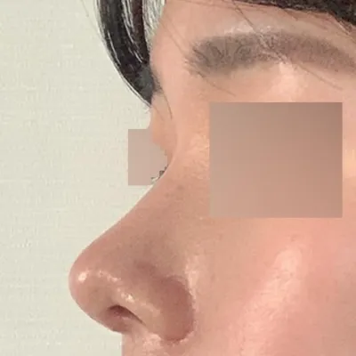 위버스성형외과에서 눈, 코 수술받은지 한달차후기!!