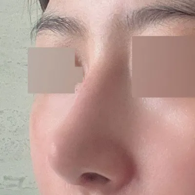 제 코 새로 태어나게 해주신 서승조 원장님 감사합니다!