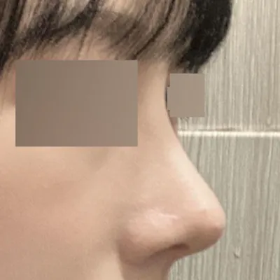 매부리코 수술한 지 3달 지났습니다!