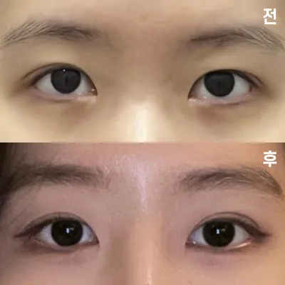 위버스 성형외과에서 수술한 지 1달차 됐어요~!