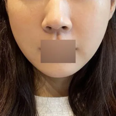 이정도면 붓기 있어도 많이 없는 편인것 같아요