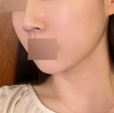 얼굴 라인 정리 잘 됐습니다 몇년은 더 어려보여서 좋아요