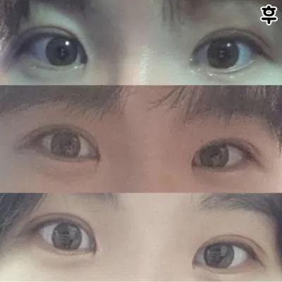 눈이 쳐져서 자신감이 없었는데 수술하고 자신감이 생겼어요 ㅠㅠㅠㅠ