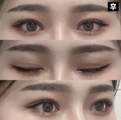 수술전보다 이뻐져서 마음에 들고 만족스러워여!