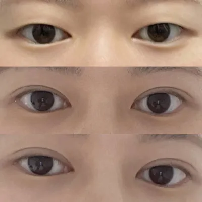 절개로 얇은 라인 성공했어용