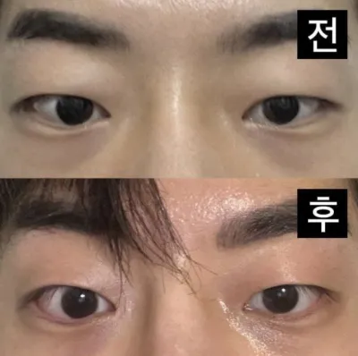 눈 뿐만 아니라 코도 엄청 성공했습니다