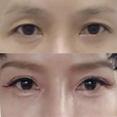 붓기도 그방 빠지고 잘 된것 같아요