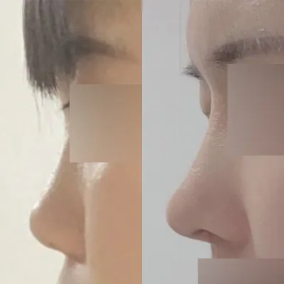 눈코수술 받은지 벌써 8달 됐어요!