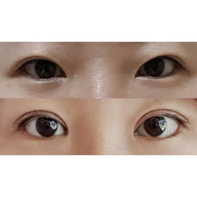 눈 수술 받은 지 한 달 좀 지났어요