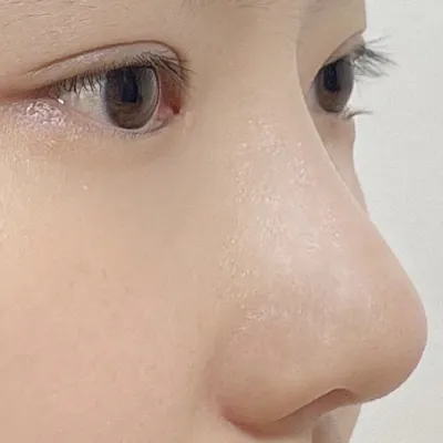 월해 4월달에 눈코 수술받고 2달차입니다ㅎㅎ