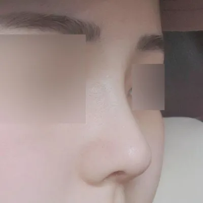 코 수술 받은 지 1달차 입니다