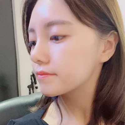 위버스 성형외과에서 코수술한지 1달차에용