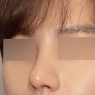 코 세번째 재수술 / 눈 첫수술 후기