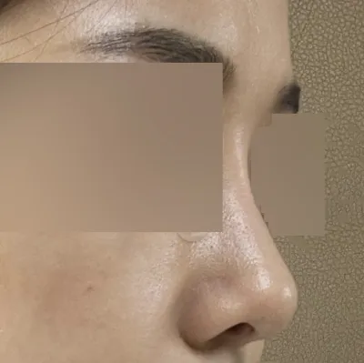 수술한지 3개월 조금 더 지난 후기입니다~