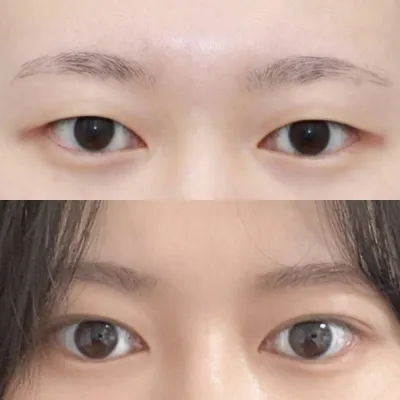 수술 3달차 후기