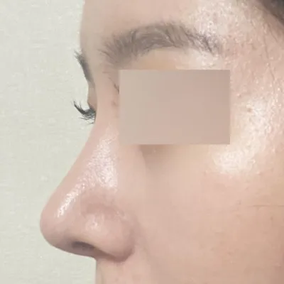 퍼진 복코 수술 2주째에용