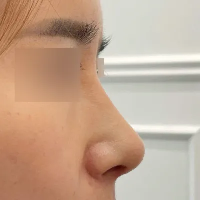 정말 예쁘게 수술 잘 됐어요^^