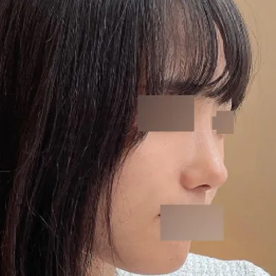 복코 수술 3달차에요