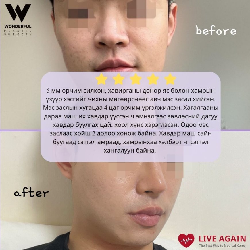 "Wonderful"  Гоо сайхны мэс заслын эмнэлэг  Before & After  Хамрын мэс засал